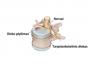 diskogeninis skausmas