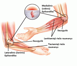 epikondilitas